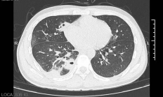 脸上痘不要随便挤！20岁男生挤了颗脸上的痘：肺被啃出10多个洞！